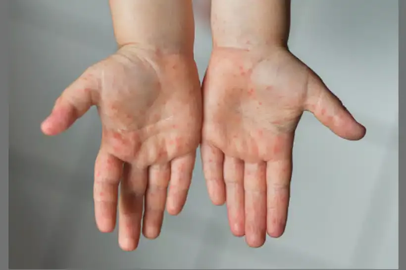 দেশের বিভিন্ন জেলায় শিশুদের মধ্যে হাম ছড়িয়ে পড়েছে।