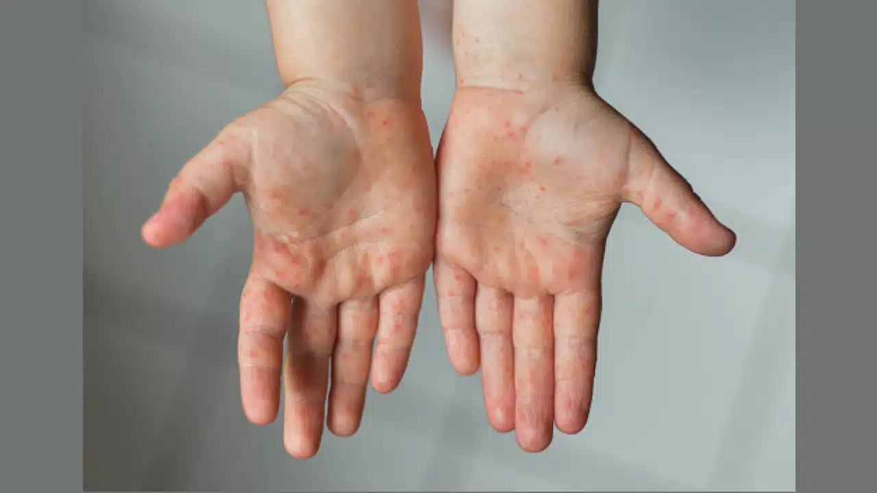 দেশের বিভিন্ন জেলায় শিশুদের মধ্যে হাম ছড়িয়ে পড়েছে।