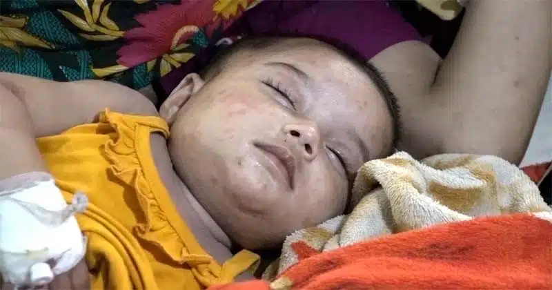 হামের উপসর্গ নিয়ে হাসপাতালে ভর্তি এক শিশু।